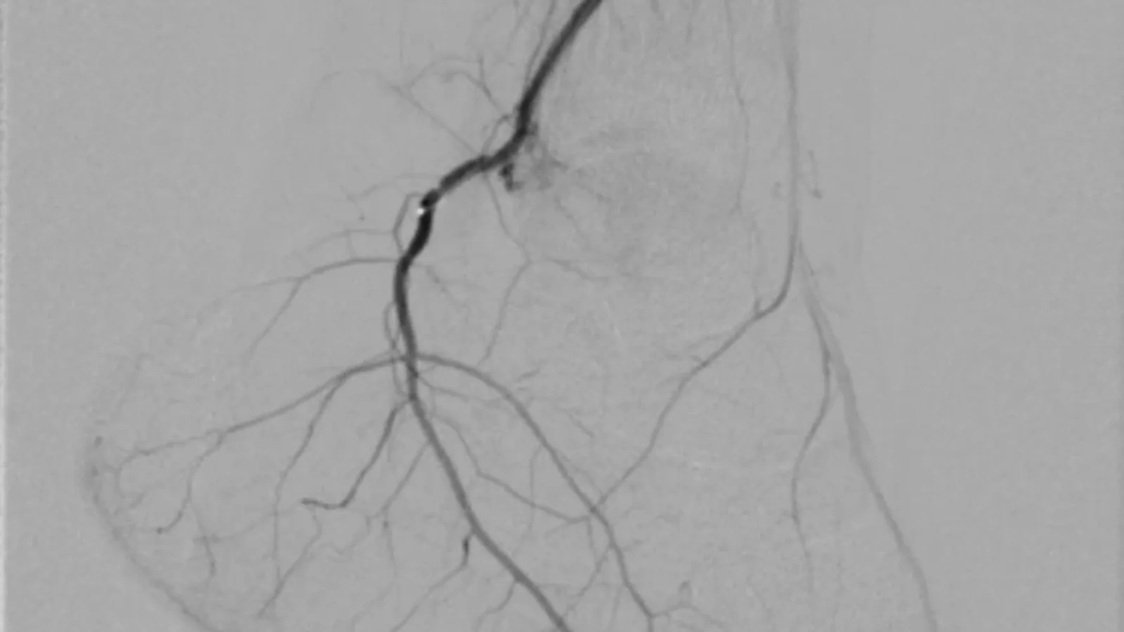 Angiogram showing the branching small arteries of a limb
