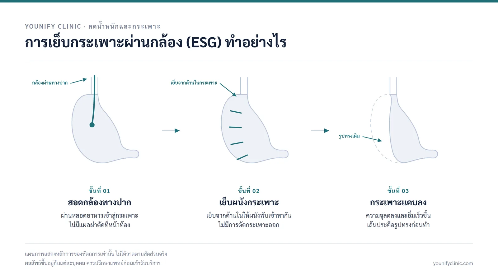 ขั้นตอนการเย็บกระเพาะผ่านกล้อง (ESG) 3 ขั้น