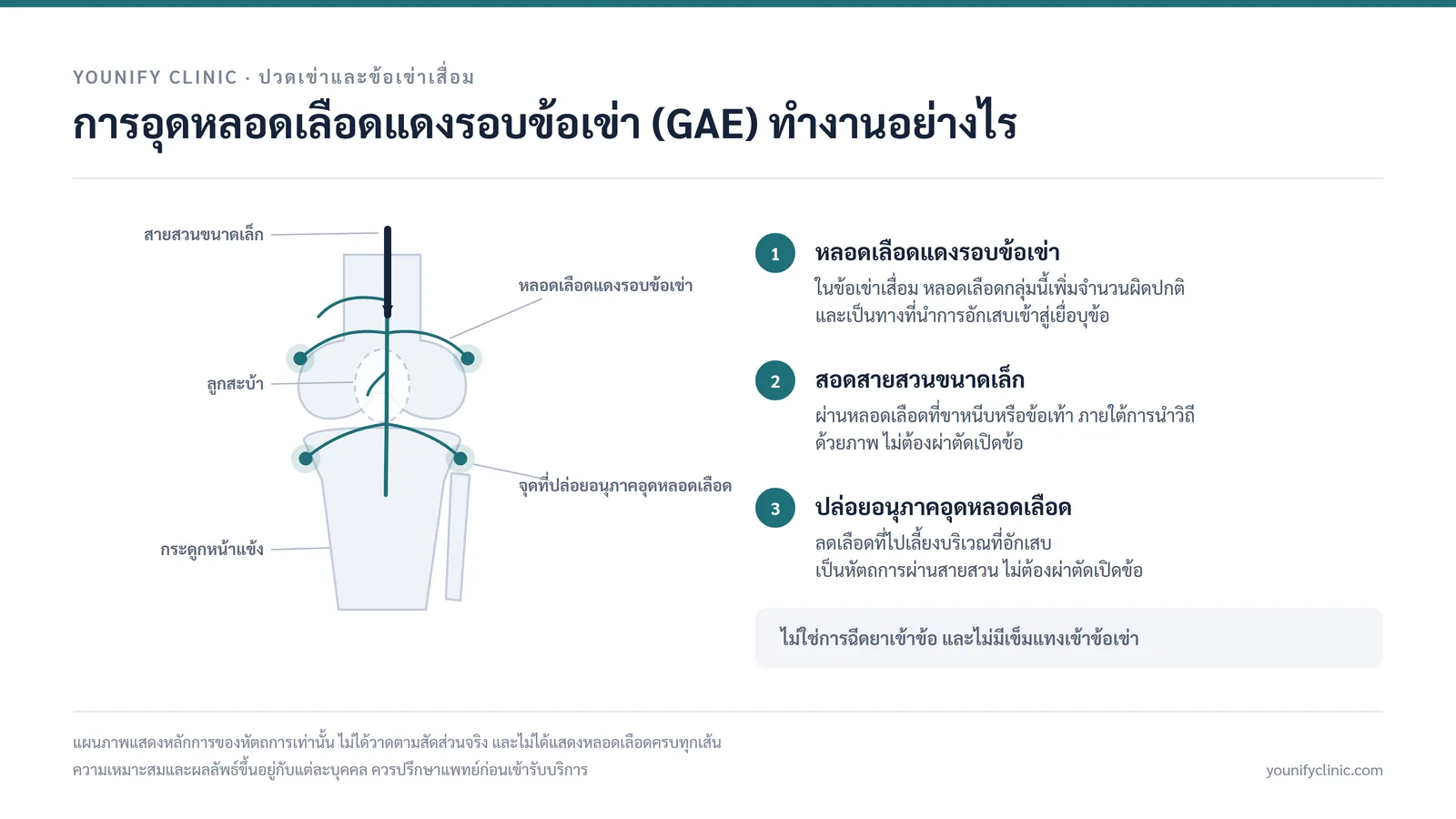 แผนภาพการอุดหลอดเลือดแดงรอบข้อเข่า (GAE) ผ่านสายสวนขนาดเล็ก ไม่ใช่การฉีดยาเข้าข้อ