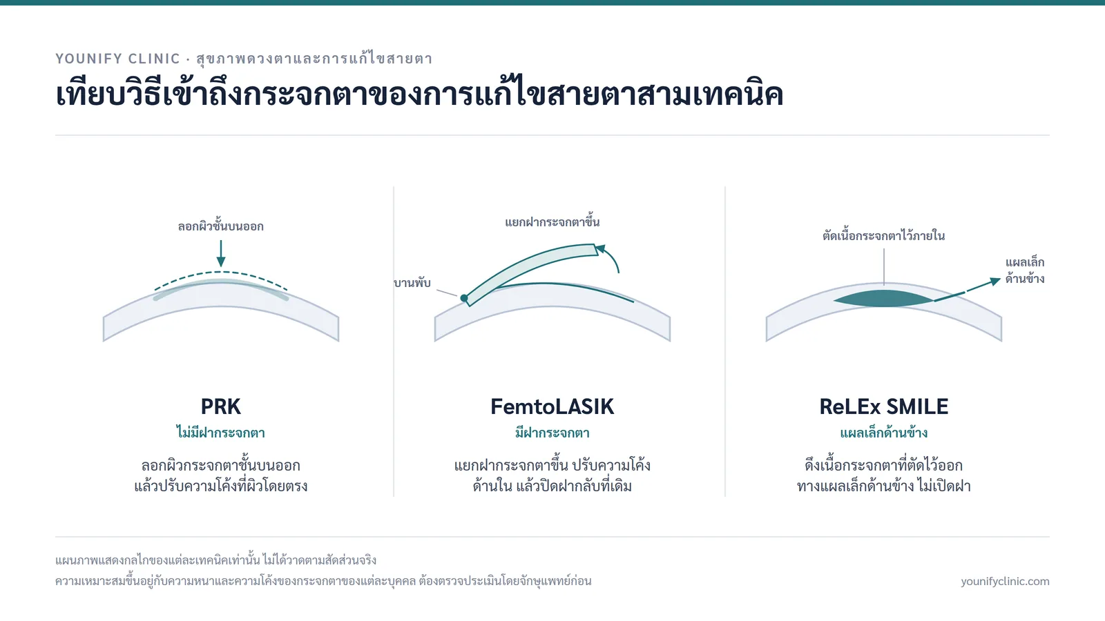 แผนภาพเทียบวิธีเข้าถึงกระจกตาของ PRK, FemtoLASIK และ ReLEx SMILE