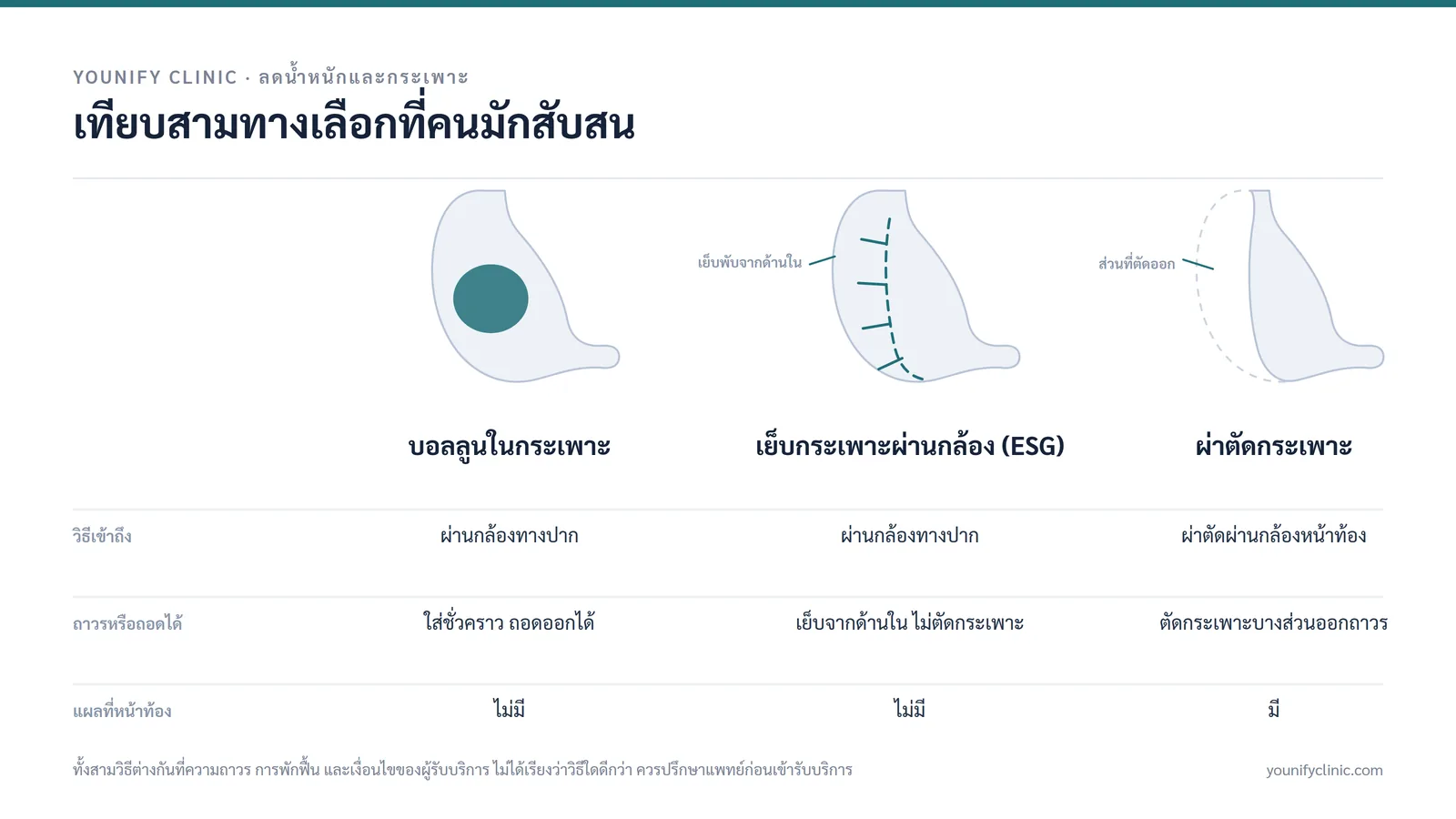 เทียบบอลลูนในกระเพาะ การเย็บกระเพาะผ่านกล้อง (ESG) และการผ่าตัดกระเพาะ