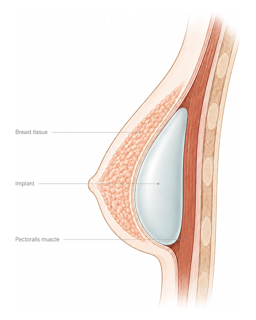 ภาพประกอบทางการแพทย์ — วางเหนือกล้ามเนื้อ (Subglandular)