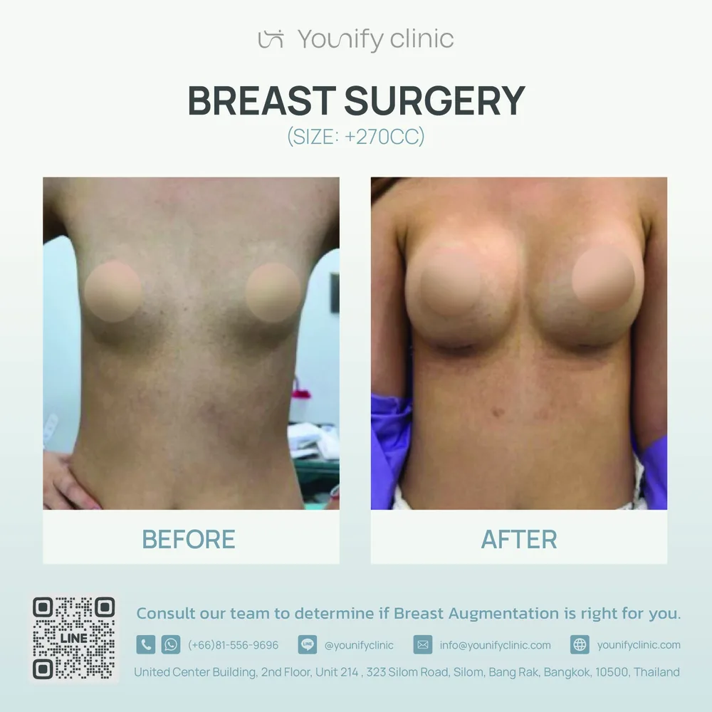 Breast augmentation before & after result — YOUNIFY Clinic