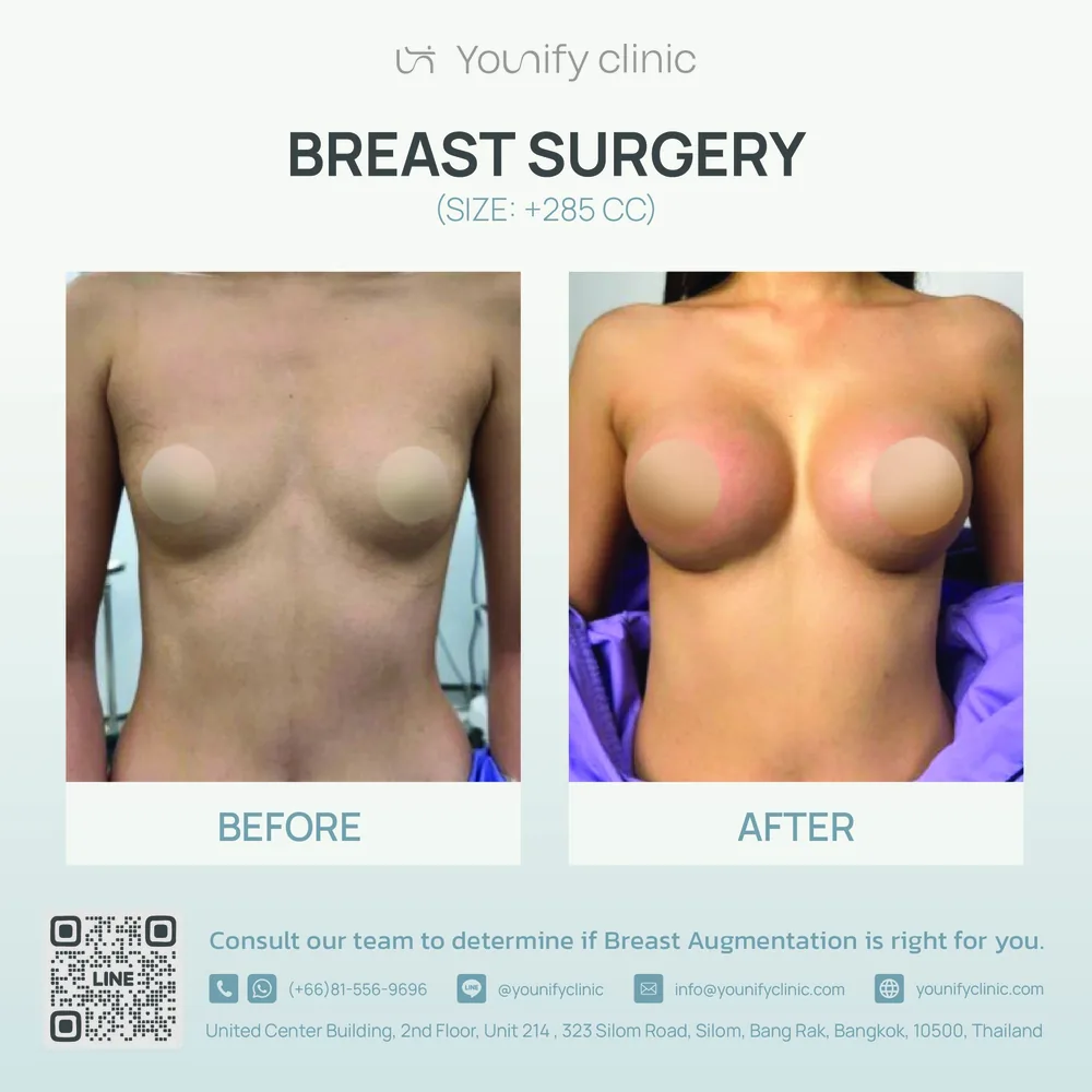 Breast augmentation before & after result — YOUNIFY Clinic