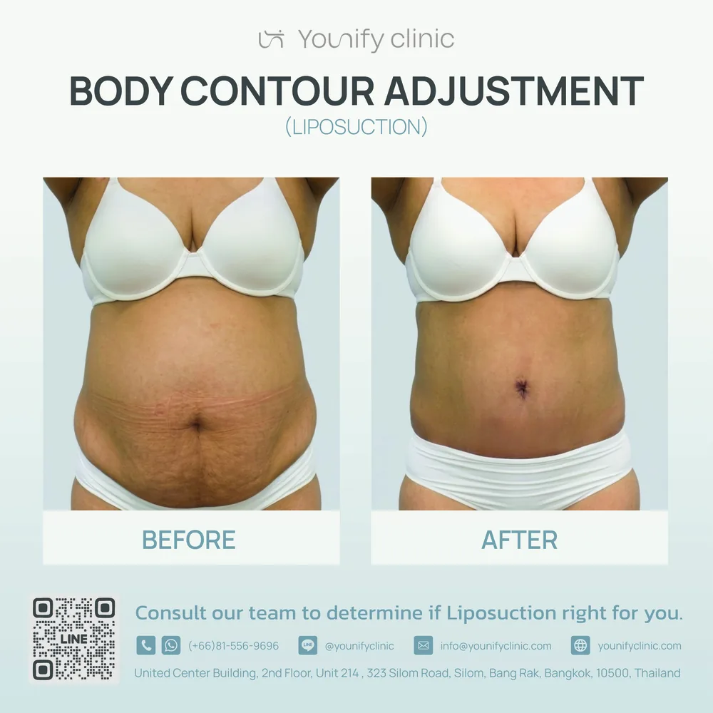 Liposuction body contouring before & after result — YOUNIFY Clinic