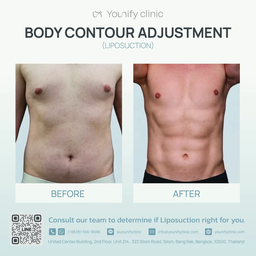 Liposuction body contouring before & after result — YOUNIFY Clinic