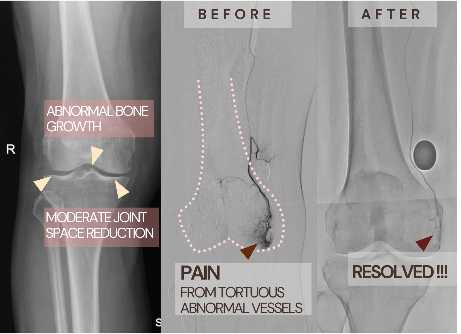 ภาพเปรียบเทียบก่อนและหลังการรักษา GAE