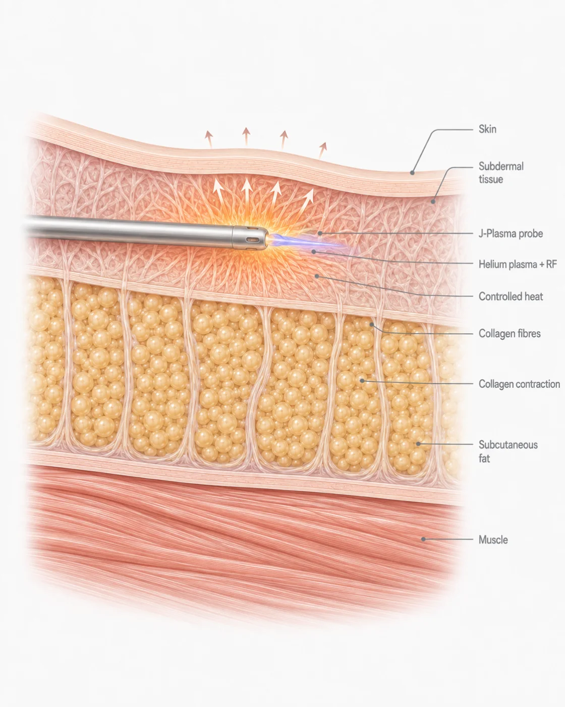 Medical illustration — Renuvion / J-Plasma (helium plasma + RF)