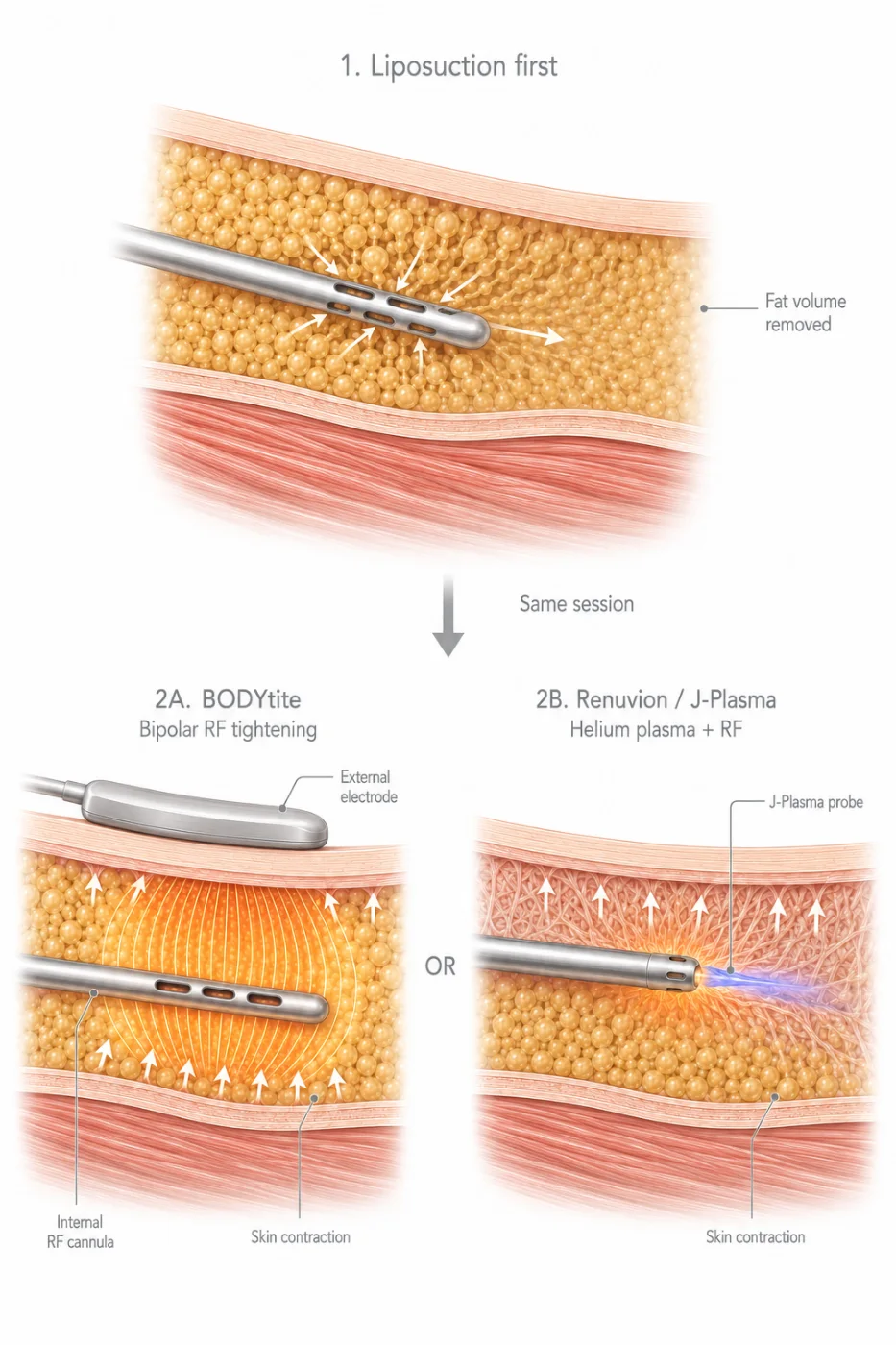 Medical illustration — Combined with liposuction